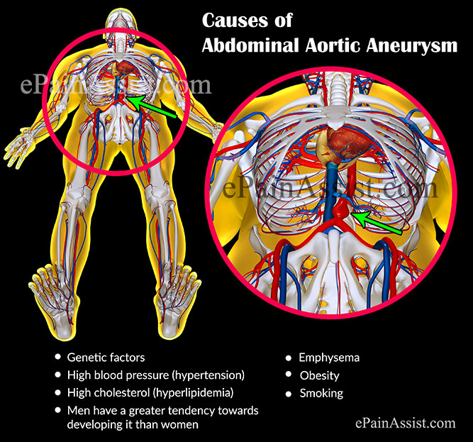 Causes and Risk Factors of Abdominal Aortic Aneurysm