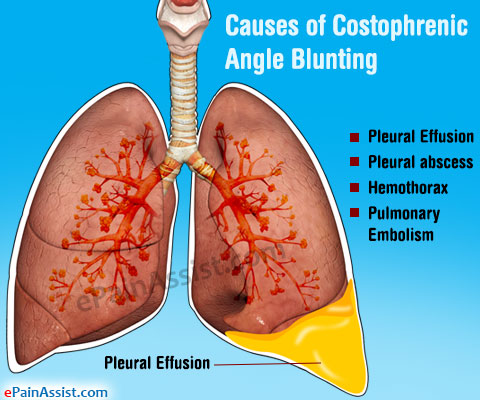 Causes of Costophrenic Angle Blunting