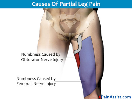 Causes Of Partial Leg Pain