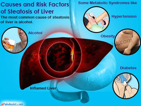 Causes and Risk Factors of Steatosis of Liver