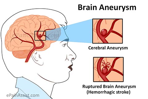 Brain Aneurysm or Cerebral Aneurysm Brain Aneurysm or Cerebral Aneurysm