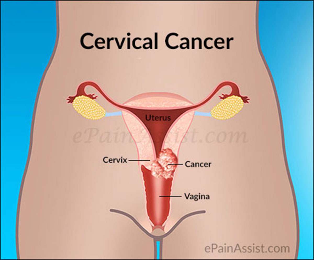 Is Cervical Cancer Curable Survival Rate Treatment Of Cervical Cancer