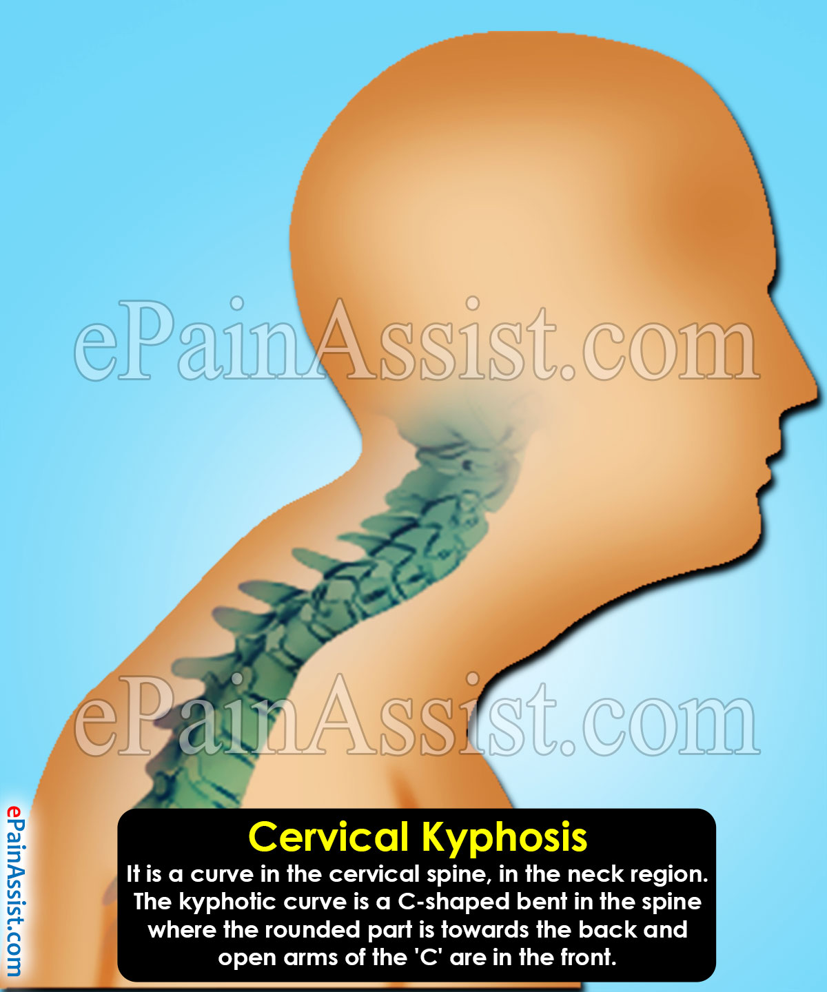 Cervical Kyphosis