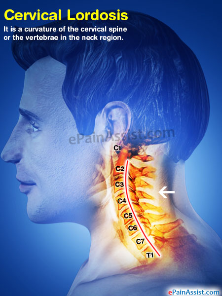 Cervical Lordosis