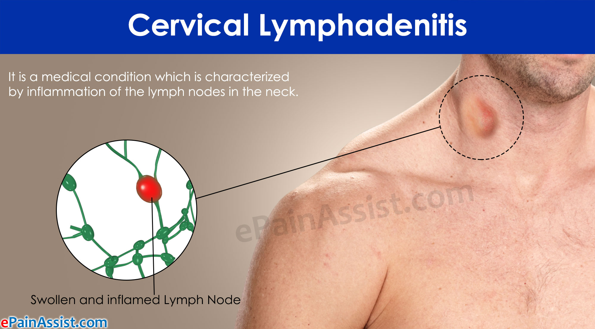 Cervical Lymphadenitis