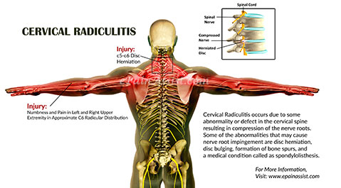 Cervical Radiculitis Cervical Radiculitis
