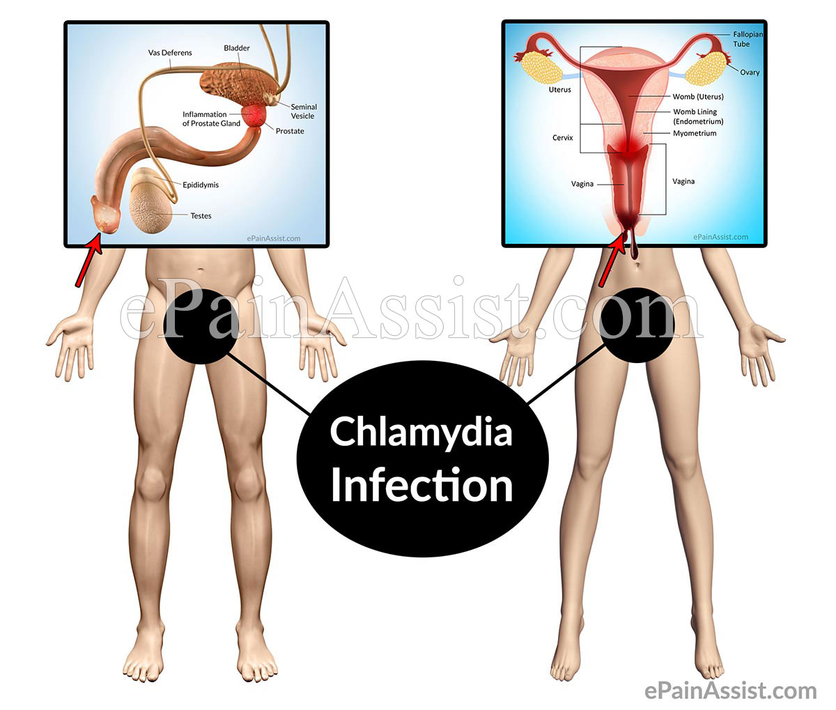 Chlamydia Infection