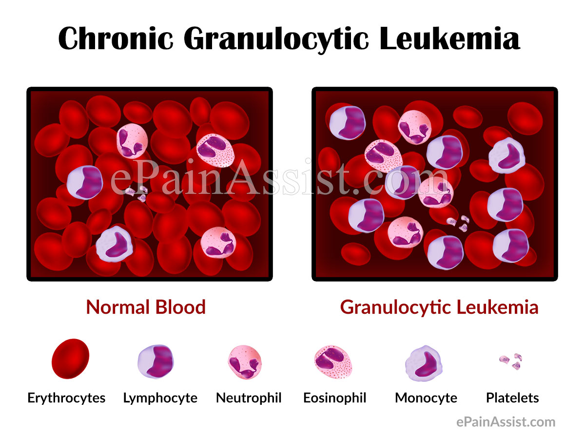 Chronic Granulocytic Leukemia Chronic Granulocytic Leukemia