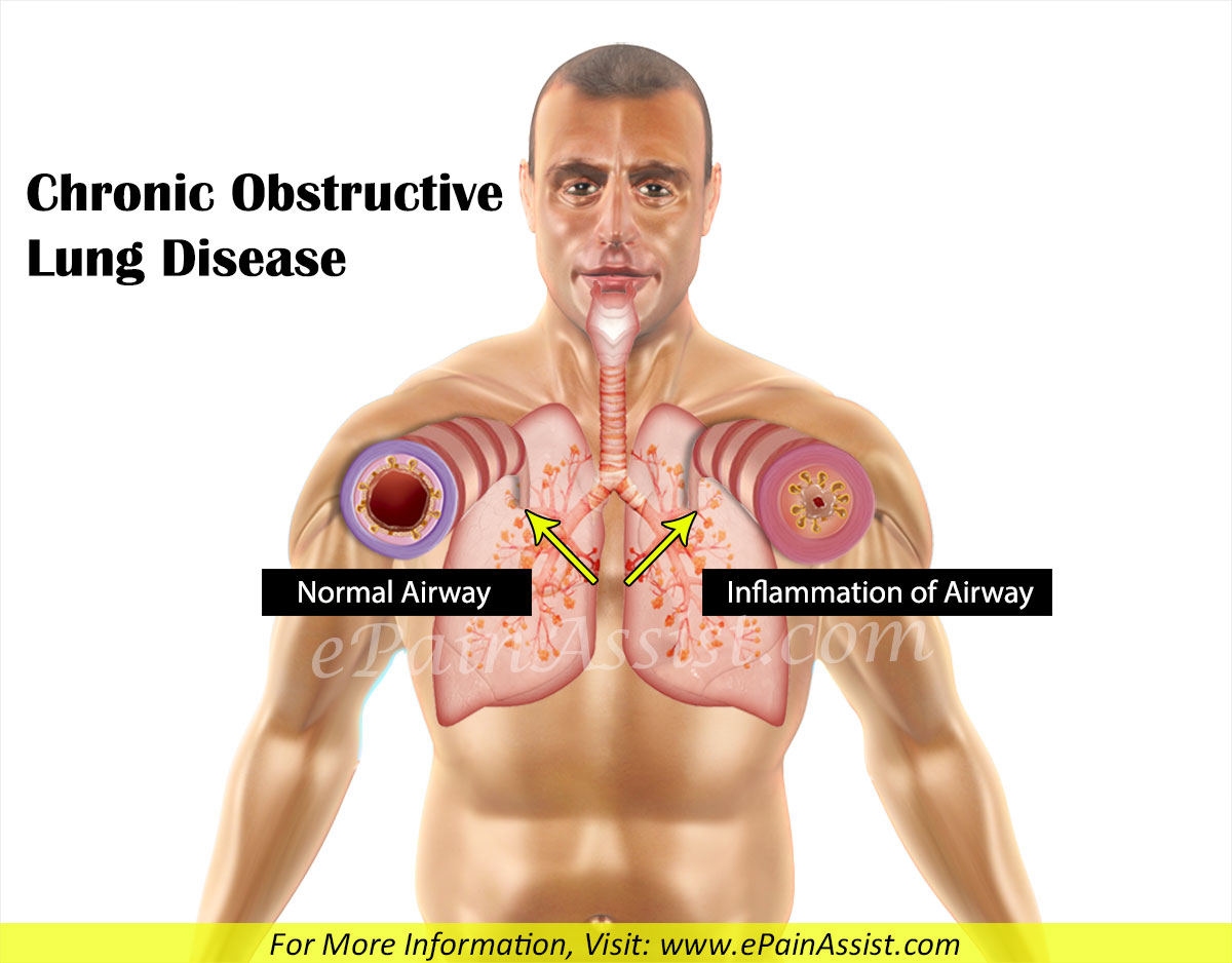 Chronic Obstructive Lung Disease Or Chronic Obstructive Airway Disease