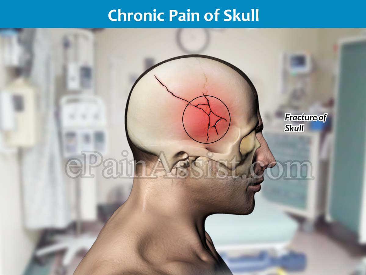 Chronic Pain of Skull Caused by Fracture of skull