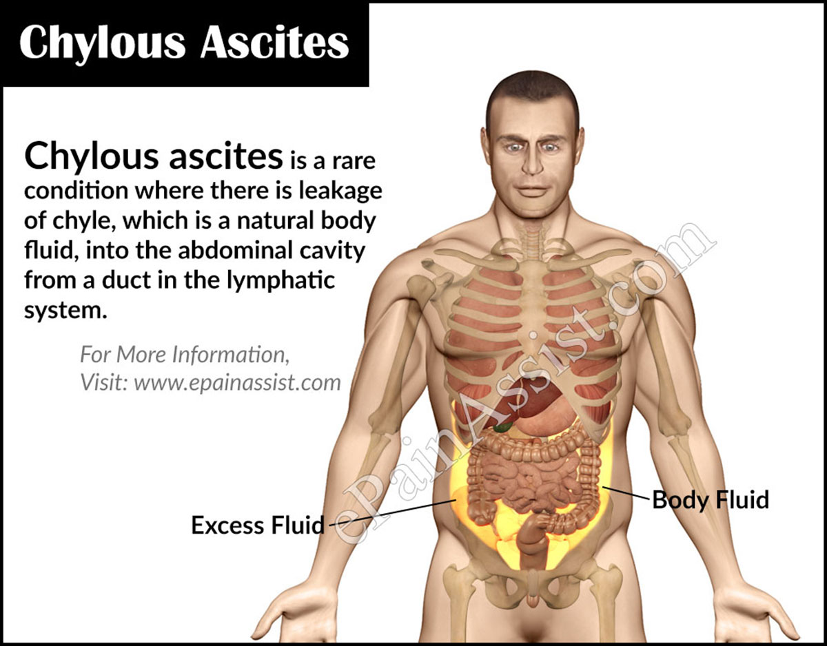 Chylous Ascites