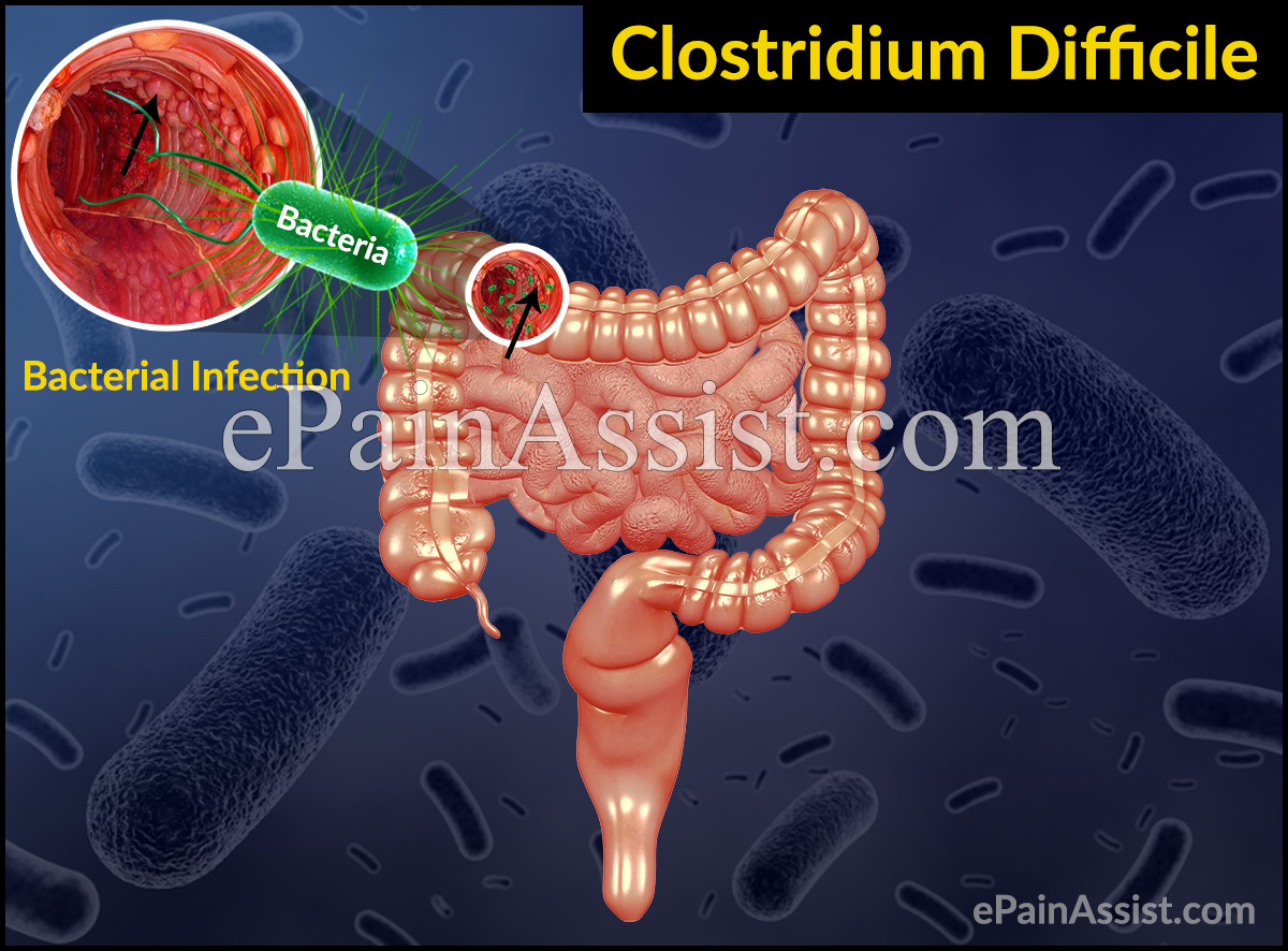 Clostridium Difficile Clostridium Difficile