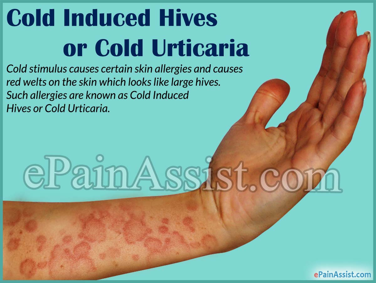 Cold Induced Hives or Cold Urticaria Cold Induced Hives or Cold Urticaria