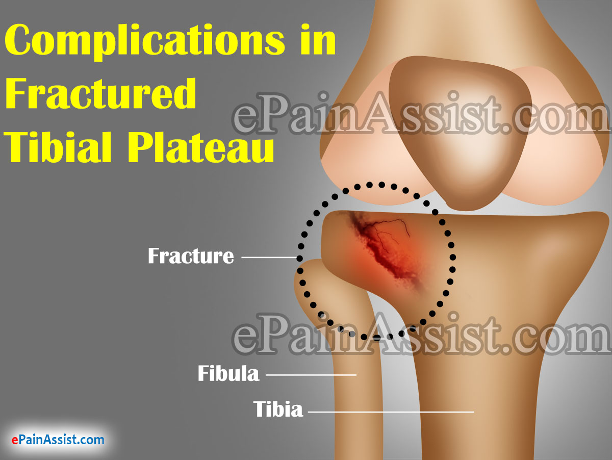 Complications in Fractured Tibial Complications in Fractured Tibial