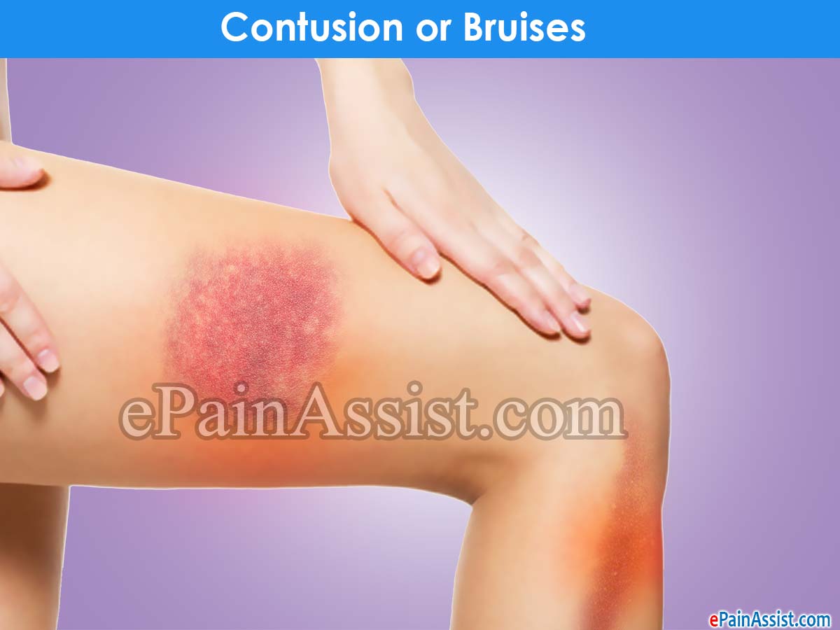 Contusion or bruises