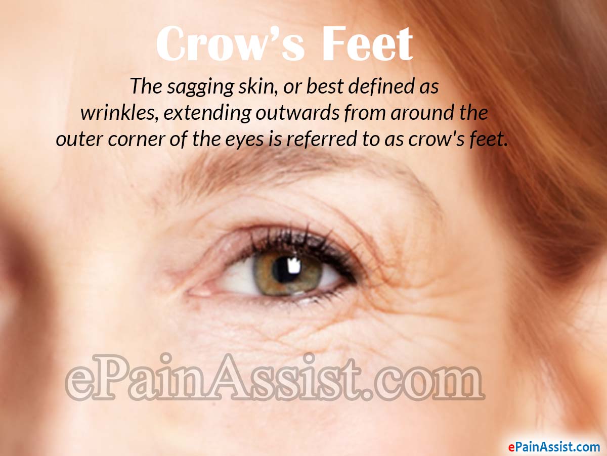 Crow’s Feet Crow’s Feet