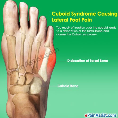 Cuboid Syndrome Causing Lateral Foot Pain