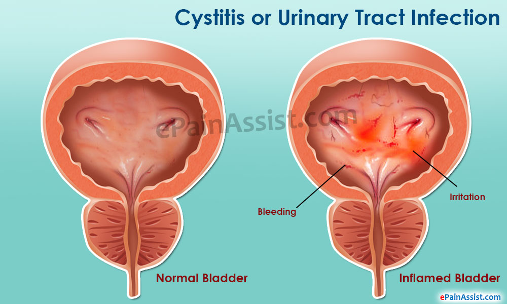 How do you treat bladder pain?