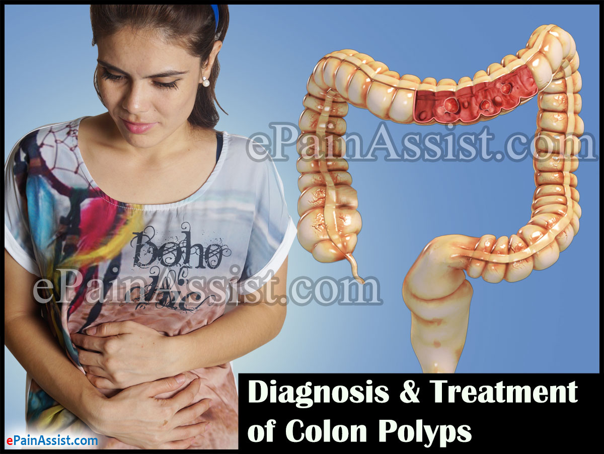 Diagnosis & Treatment of Colon Polyps Diagnosis & Treatment of Colon Polyps
