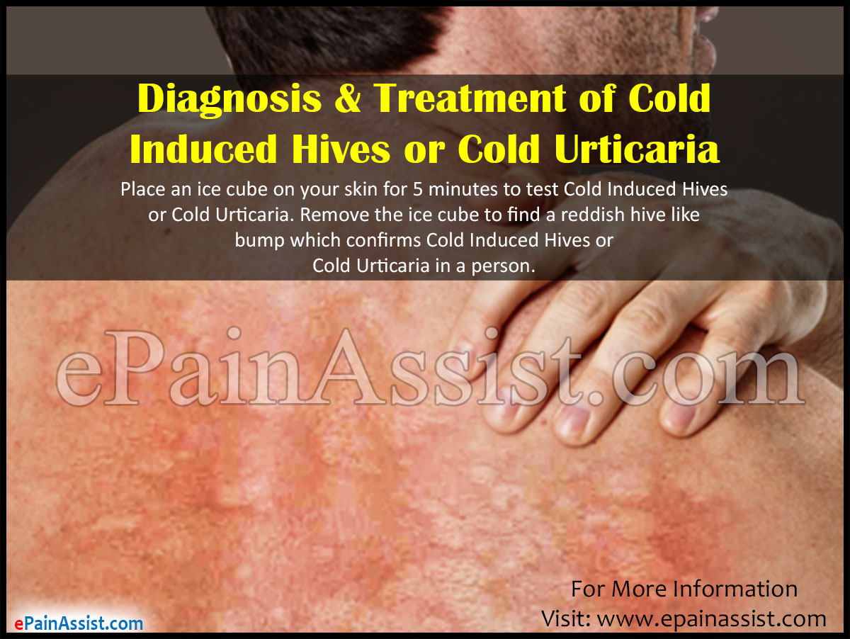 Diagnosis & Treatment of Cold Induced Hives or Cold Urticaria Diagnosis & Treatment of Cold Induced Hives or Cold Urticaria