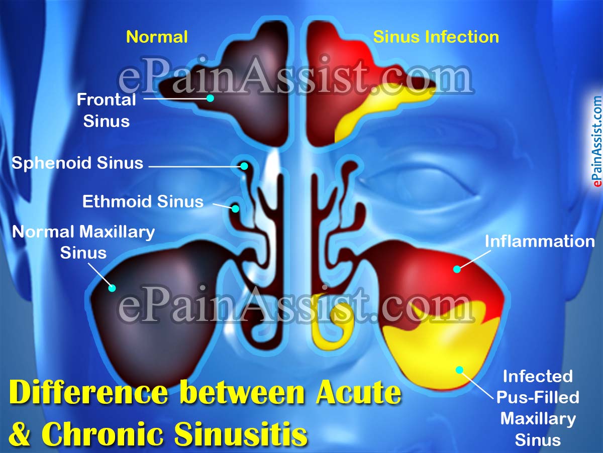 Difference between Acute & Chronic Sinusitis