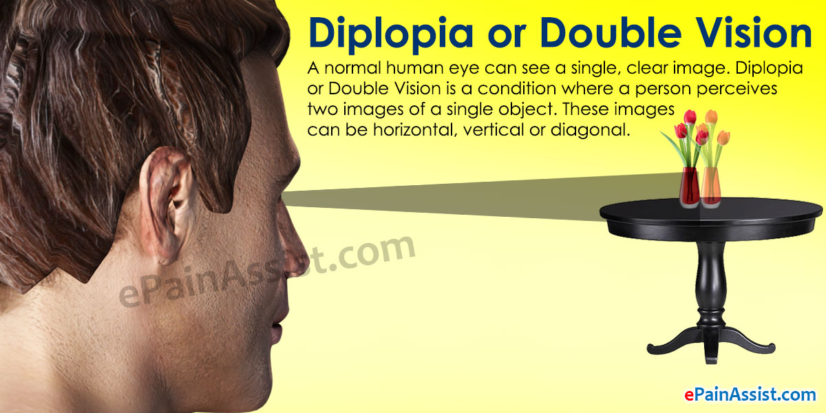 Diplopia Or Double Vision Causes Symptoms Tests Treatment