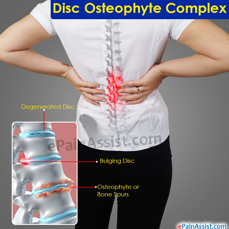 Disc Osteophyte Complex