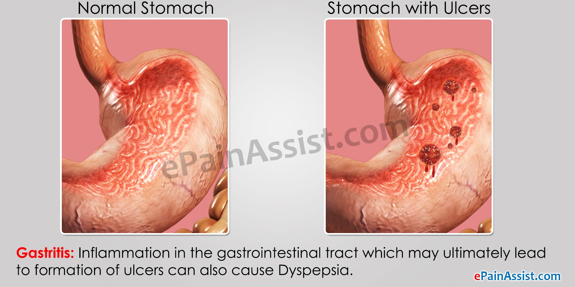 Alimentación en gastritis