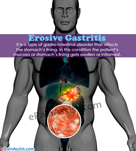 Erosive Gastritis Causes Symptoms Treatment Home Remedies Diet