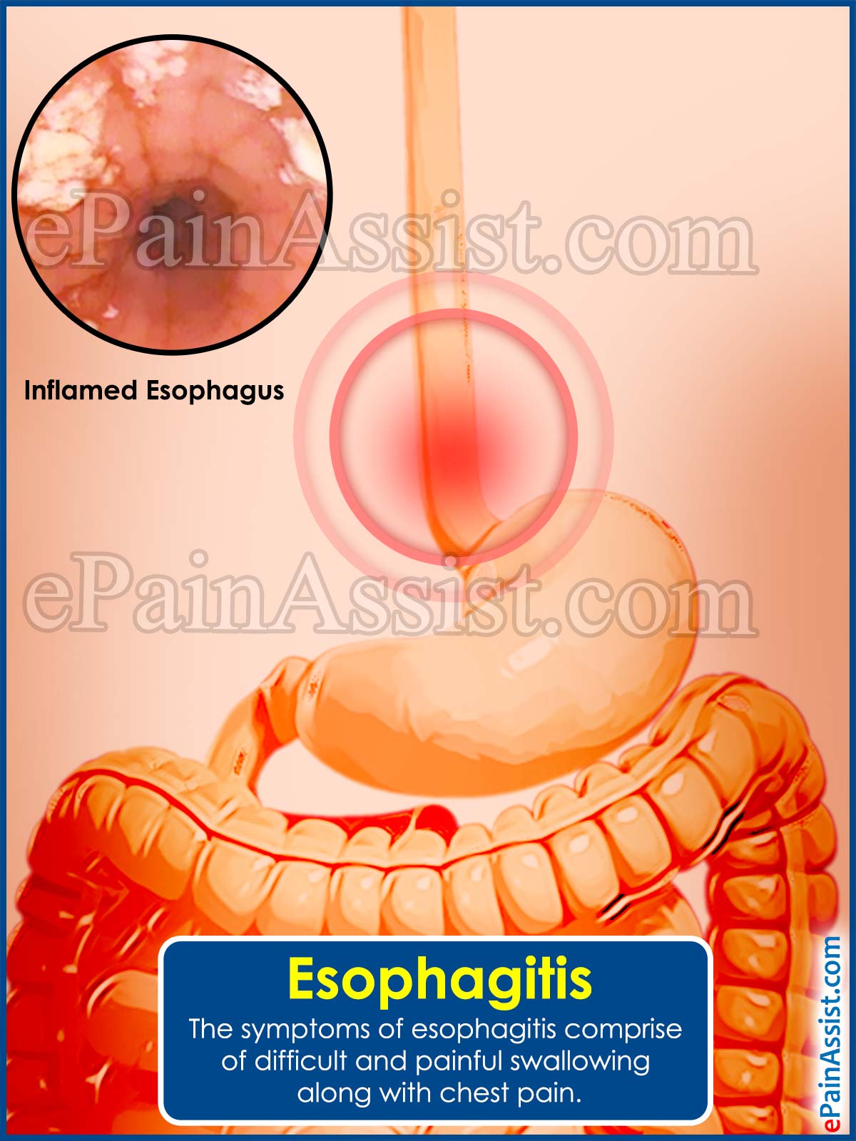 Esophagitis