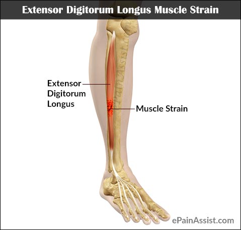 Extensor Digitorum Longus Muscle Strain Extensor Digitorum Longus Muscle Strain