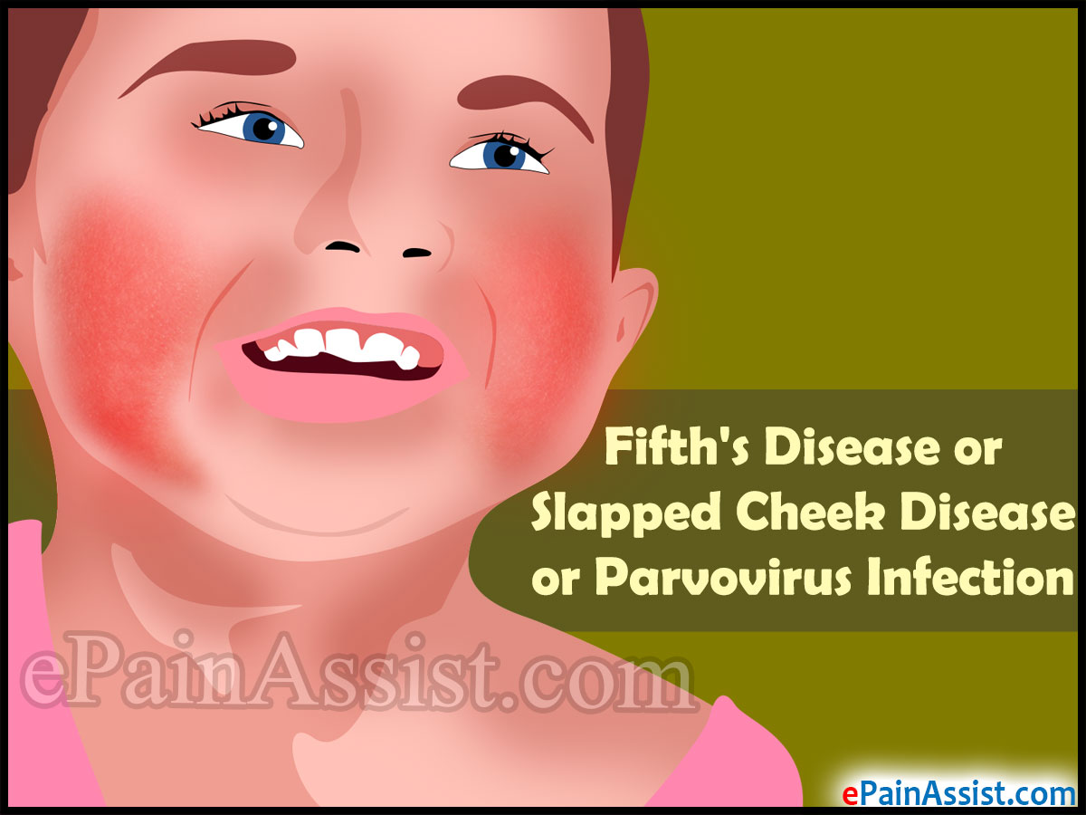 Fifth's Disease or Slapped Cheek Disease or Parvovirus Infection Fifth's Disease or Slapped Cheek Disease or Parvovirus Infection