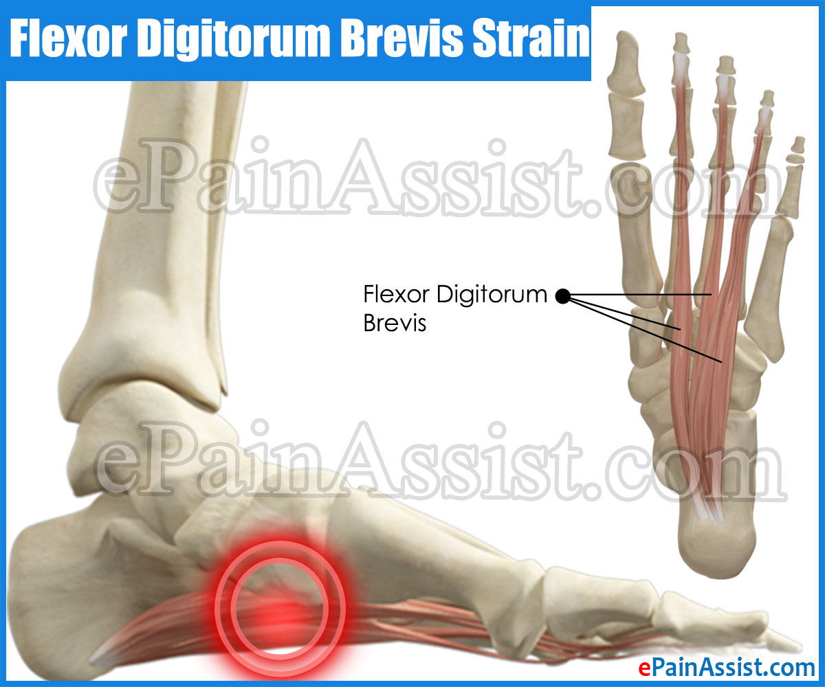 Flexor Digitorum Brevis Strain Flexor Digitorum Brevis Strain