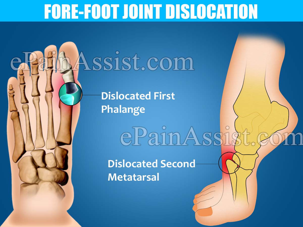 Fore-Foot Joint Dislocation Fore-Foot Joint Dislocation