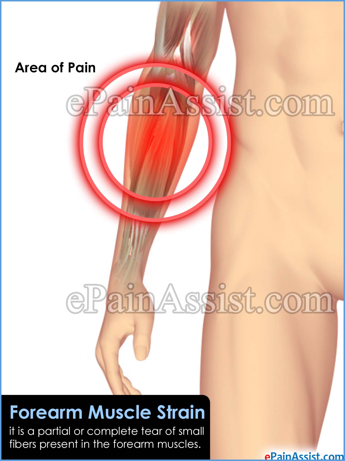 Forearm Muscle Strain Forearm Muscle Strain
