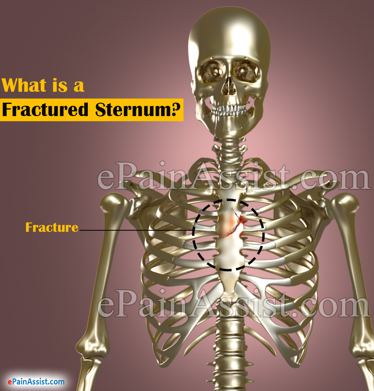 What is a Fractured Sternum