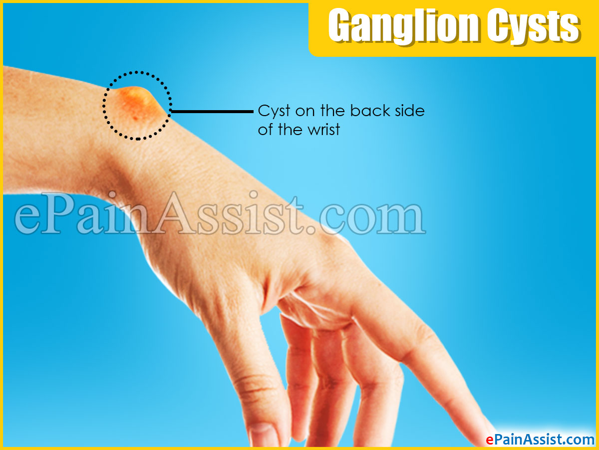 Ganglion Cysts Ganglion Cysts
