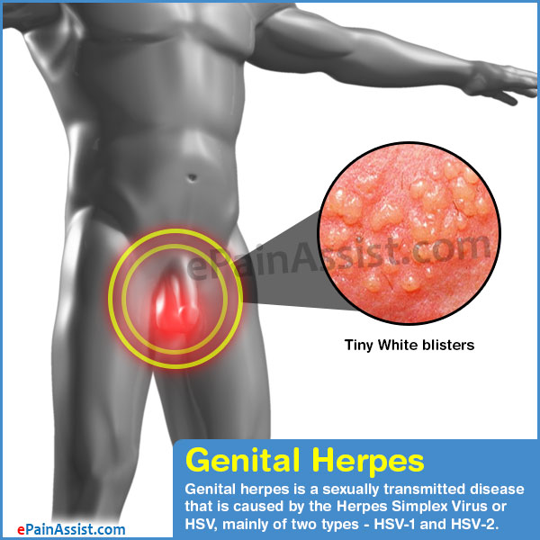 Genital Herpes Causes Symptoms Treatment Prevention Pregnancy