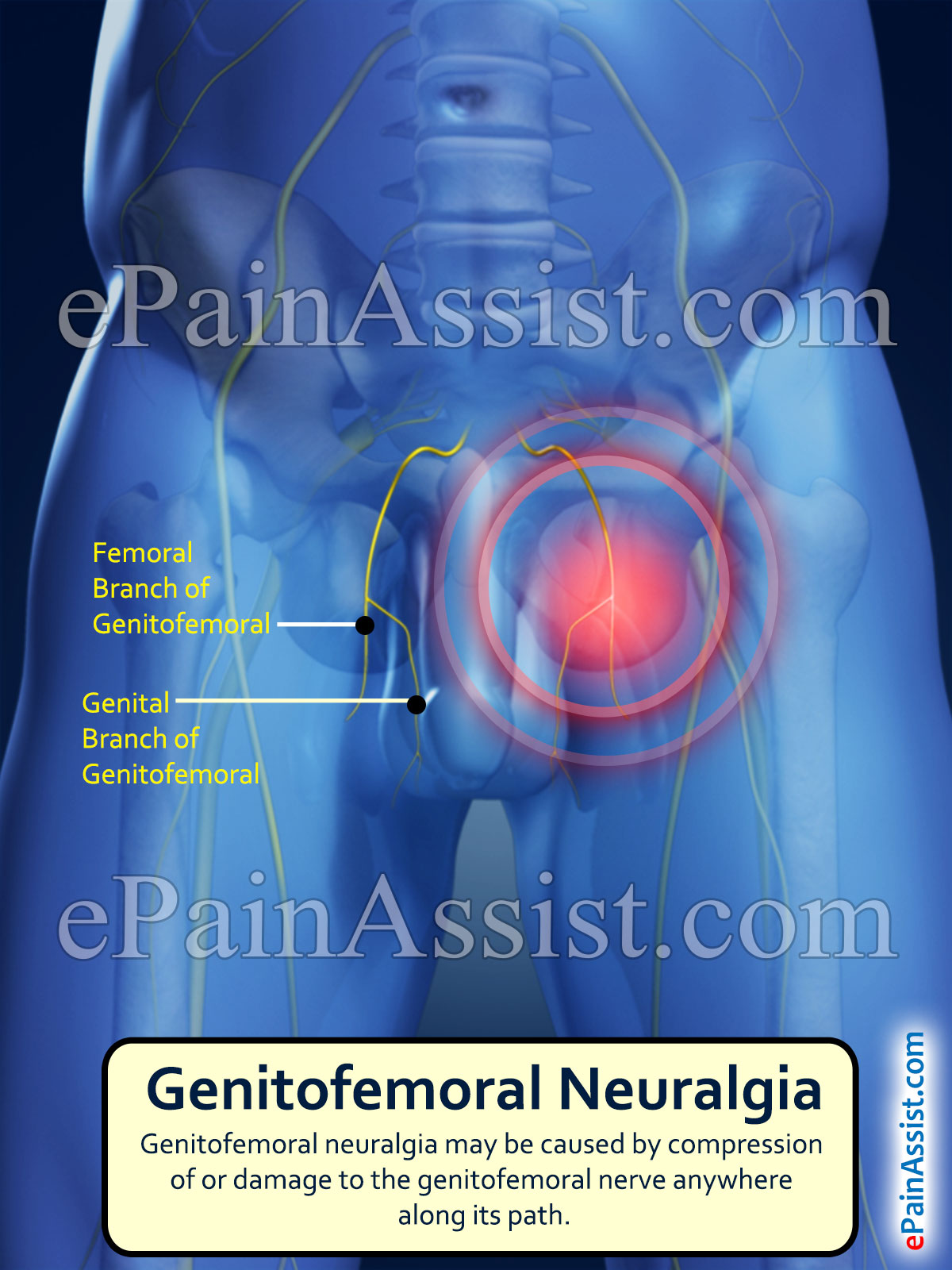 Genitofemoral Neuralgia: Treatment, Causes, Symptoms, Types