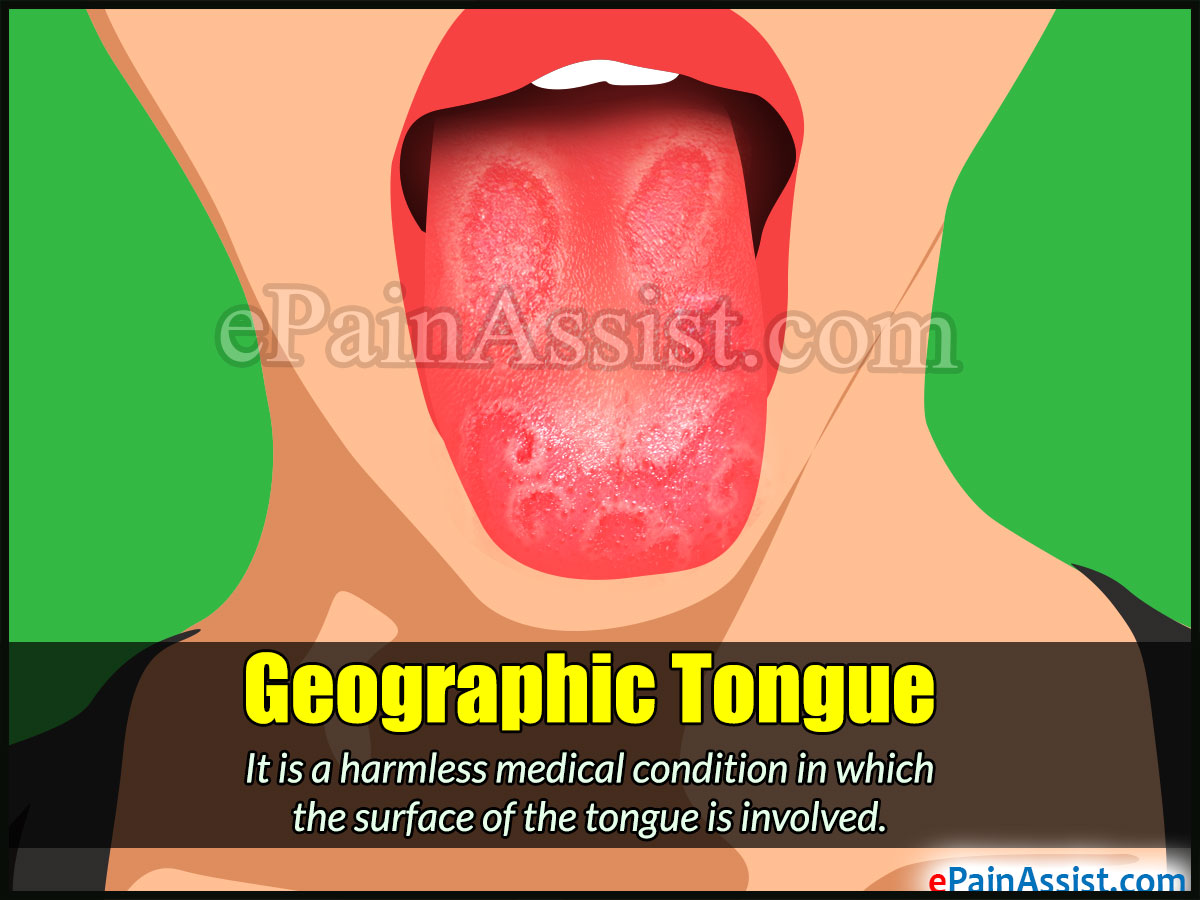 Geographic Tongue Pictures Image Geographic Tongue DDVLNE Geographic Tongue Pictures Image Geographic Tongue DDVLNE