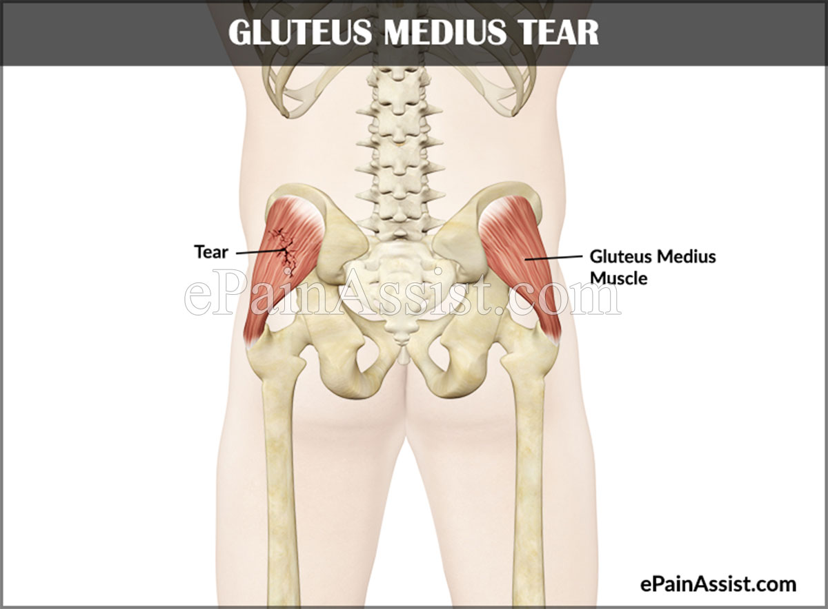 Gluteus Medius Tear