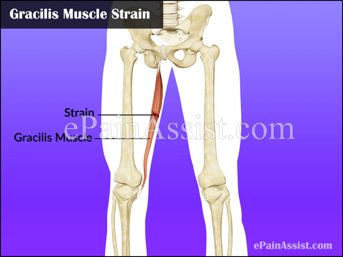 Gracilis Muscle Strain