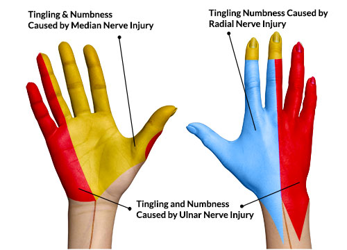 Abnormal Sensory Nerve Symptoms Of Radial Nerve Injury.