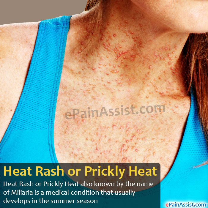 Prickly Heat Rash In Adults 45