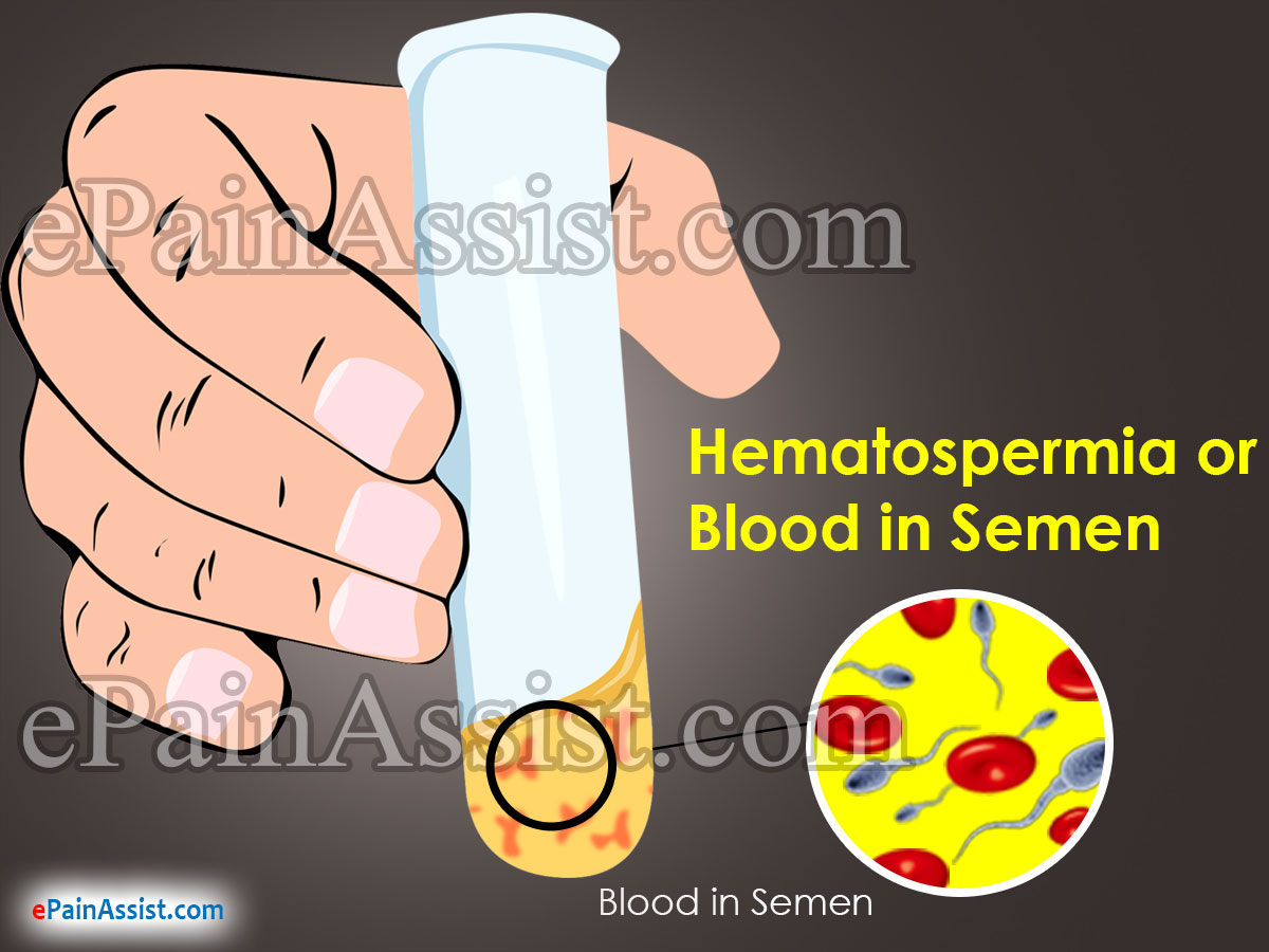 Hematospermia or Blood in Semen Hematospermia or Blood in Semen