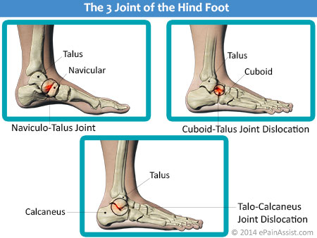 Hind-Foot Joint Dislocation