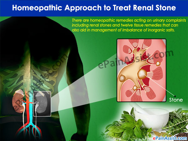 Homeopathic Approach to Treat Renal Stone