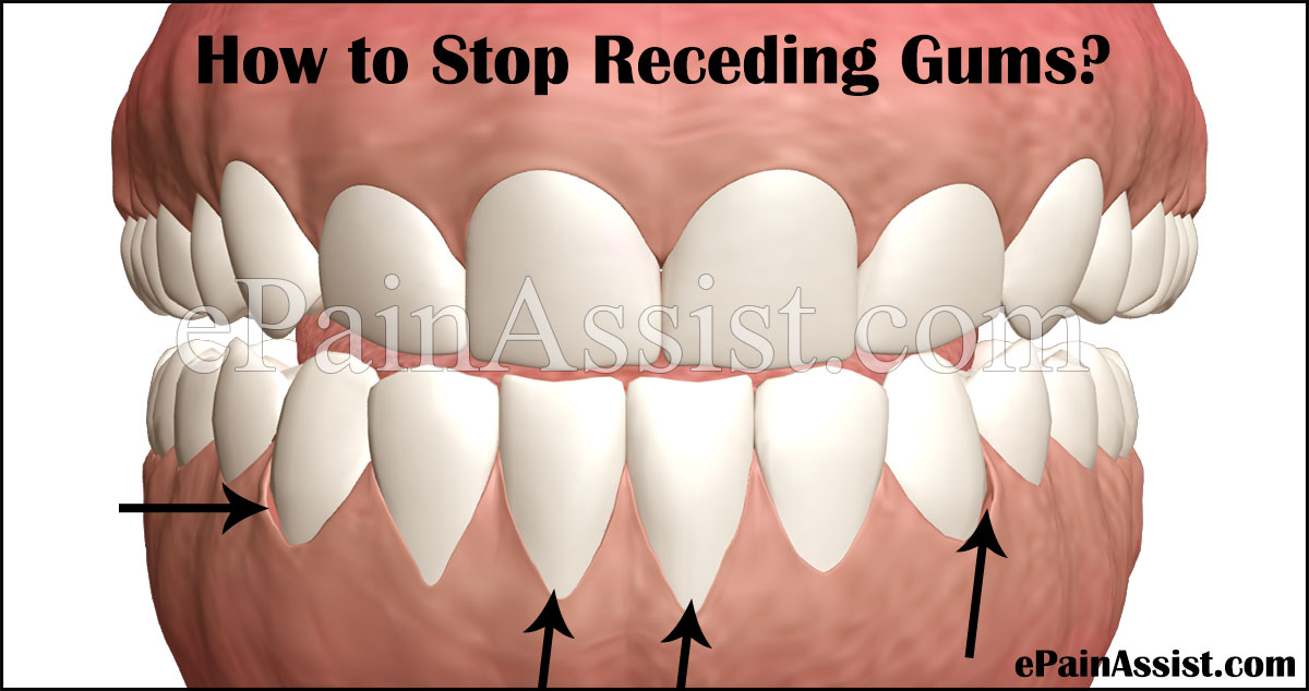 How to Stop Receding Gums How to Stop Receding Gums