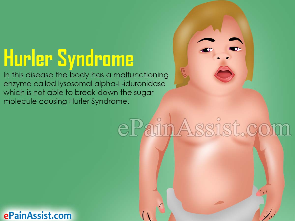 Hurler Syndrome Hurler Syndrome