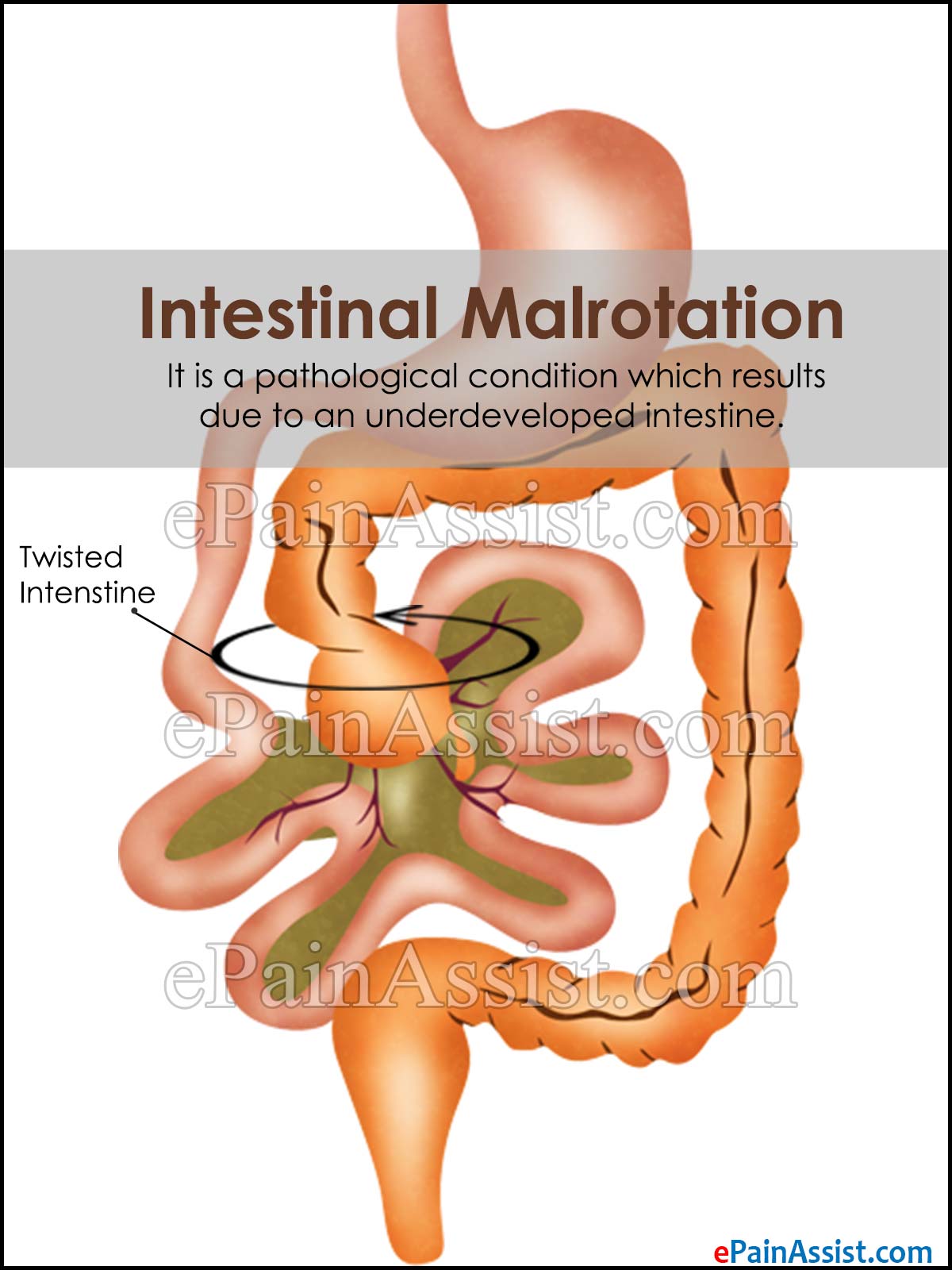 Intestinal Malrotation Intestinal Malrotation